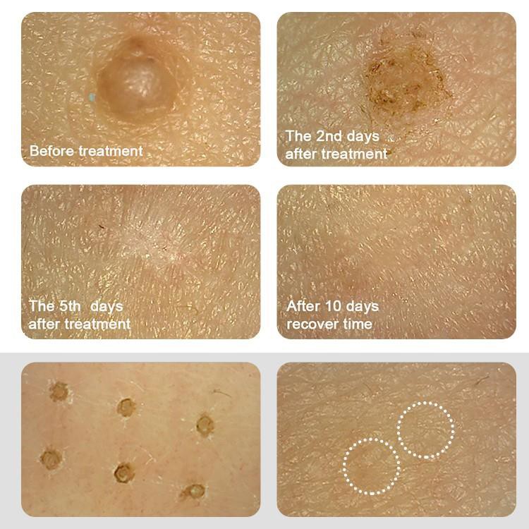 plasma pen eyebrow lift